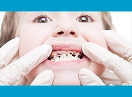 Dental Caries / Decay / Cavities