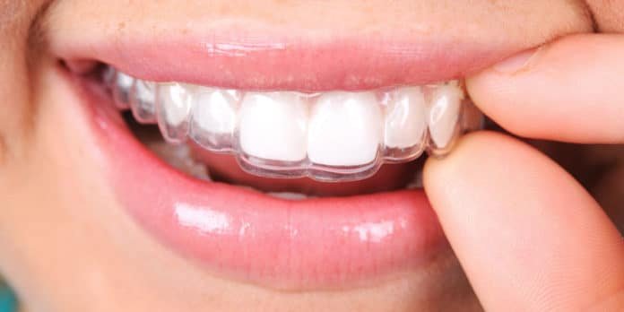 invisible-braces-cost-in-hyderabad-lavanya-dental-clinic