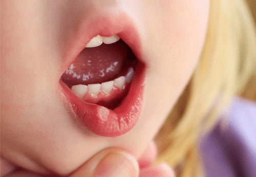 Child-with-mouth-ulcer