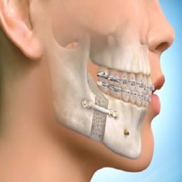 Presurgical-Orthodontics