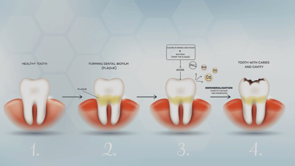 Tooth Decay Causes, Symptoms, Diagnosis & Treatment