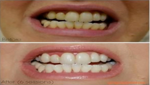 teeth whitening result