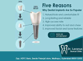 dental implants in madhapur