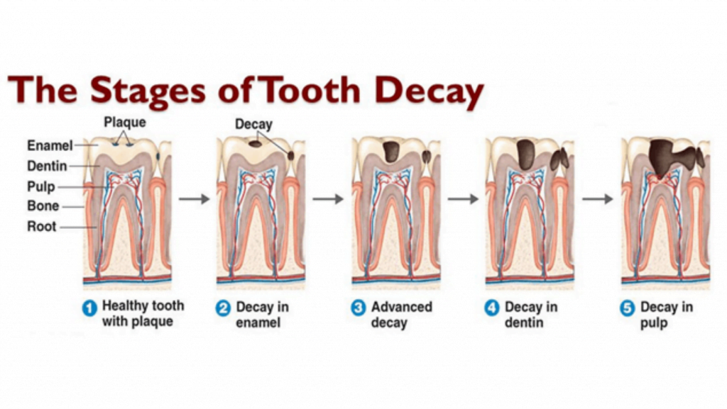 The Stages of Tooth Decay