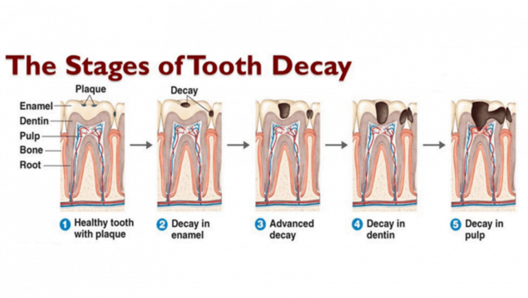 Tooth Decay Causes Symptoms Diagnosis Treatment Lavanya