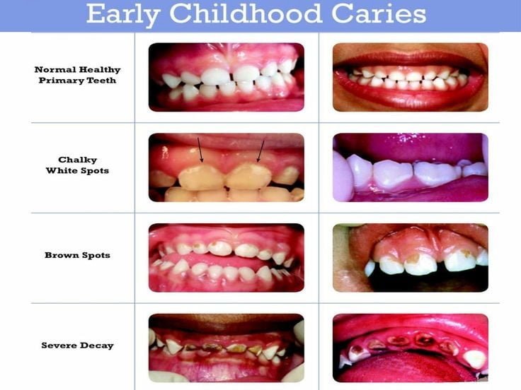 PROGRESSION OF EARLY CHILDHOOD DECAY