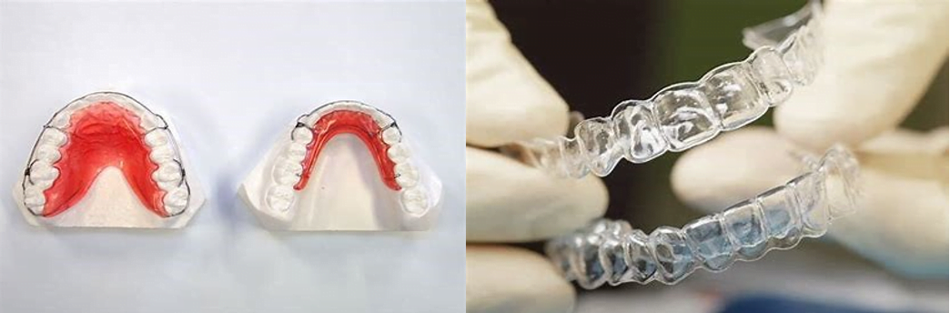 Fixed Retainer/ Permanent Retainer/ Bonded Retainer 