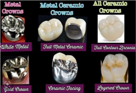 Types of Zirconia