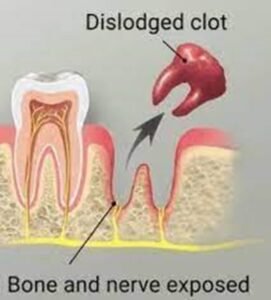 Dislodged clot