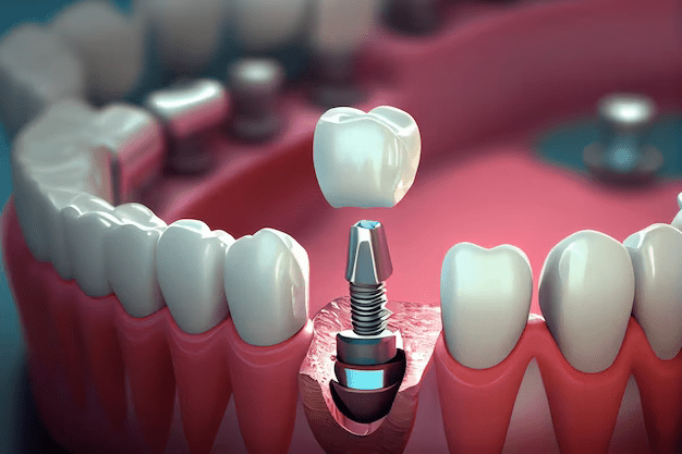 Denture Treatment | Dental Implants Treatment In Hyderabad