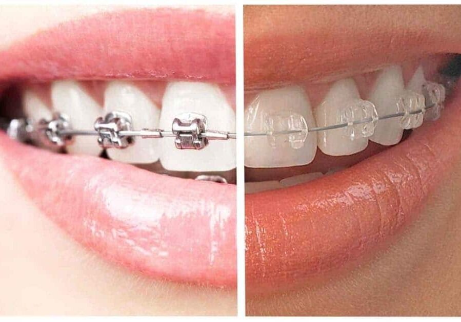 The Journey to a Perfect Smile: Understanding Braces for All Ages