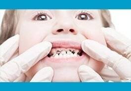 Dental Caries / Decay / Cavities