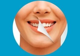 DENTAL SCALING / PROPHYLAXIS / CLEANING